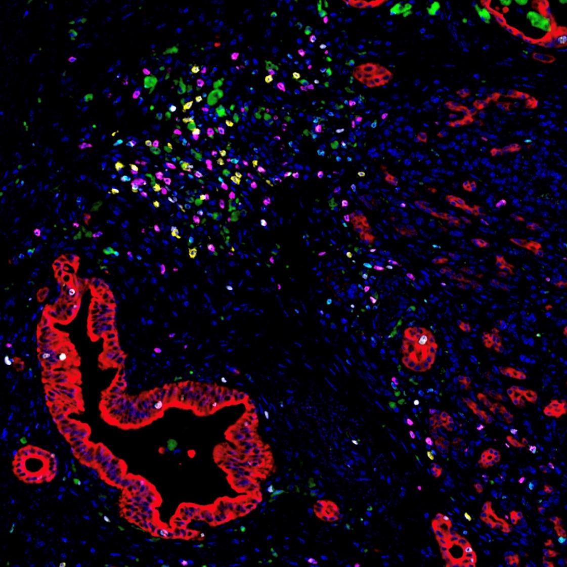 Fluorescent image of immune cells clustered around pancreatic cancer cells
